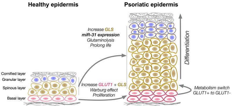 Sino-Dutch Research Team Publishes Breakthrough Results in Top European Journal, Revealing Molecular Mechanisms of Immune-Metabolic Interactions in Psoriasis Progression